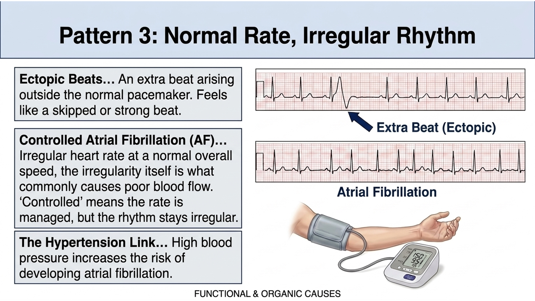 Causes of palpitations with normal rate and irregular rhythm, ectopic beats and controlled AF