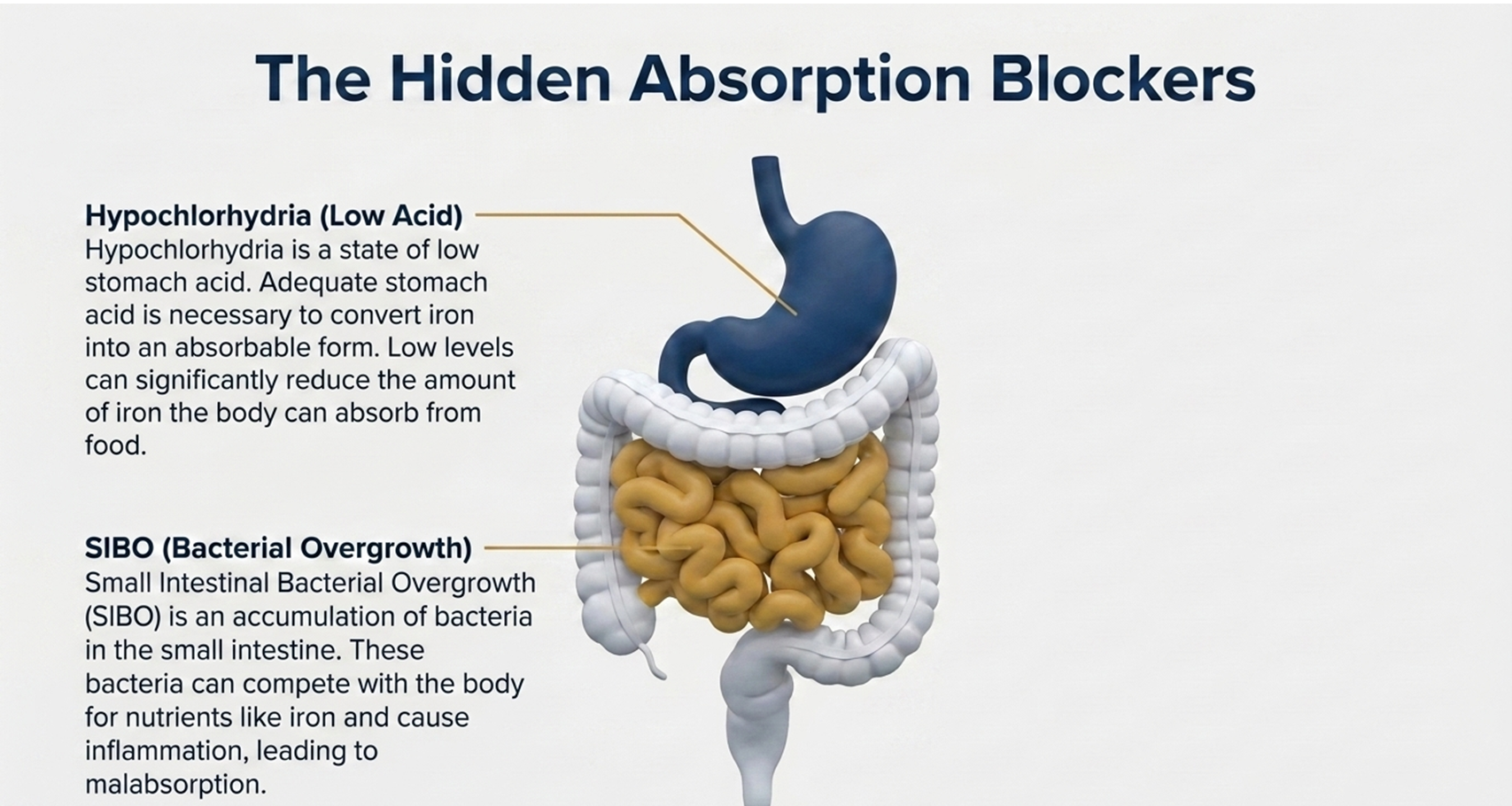 hypochlorhydria and SIBO as hidden absorption blockers for iron