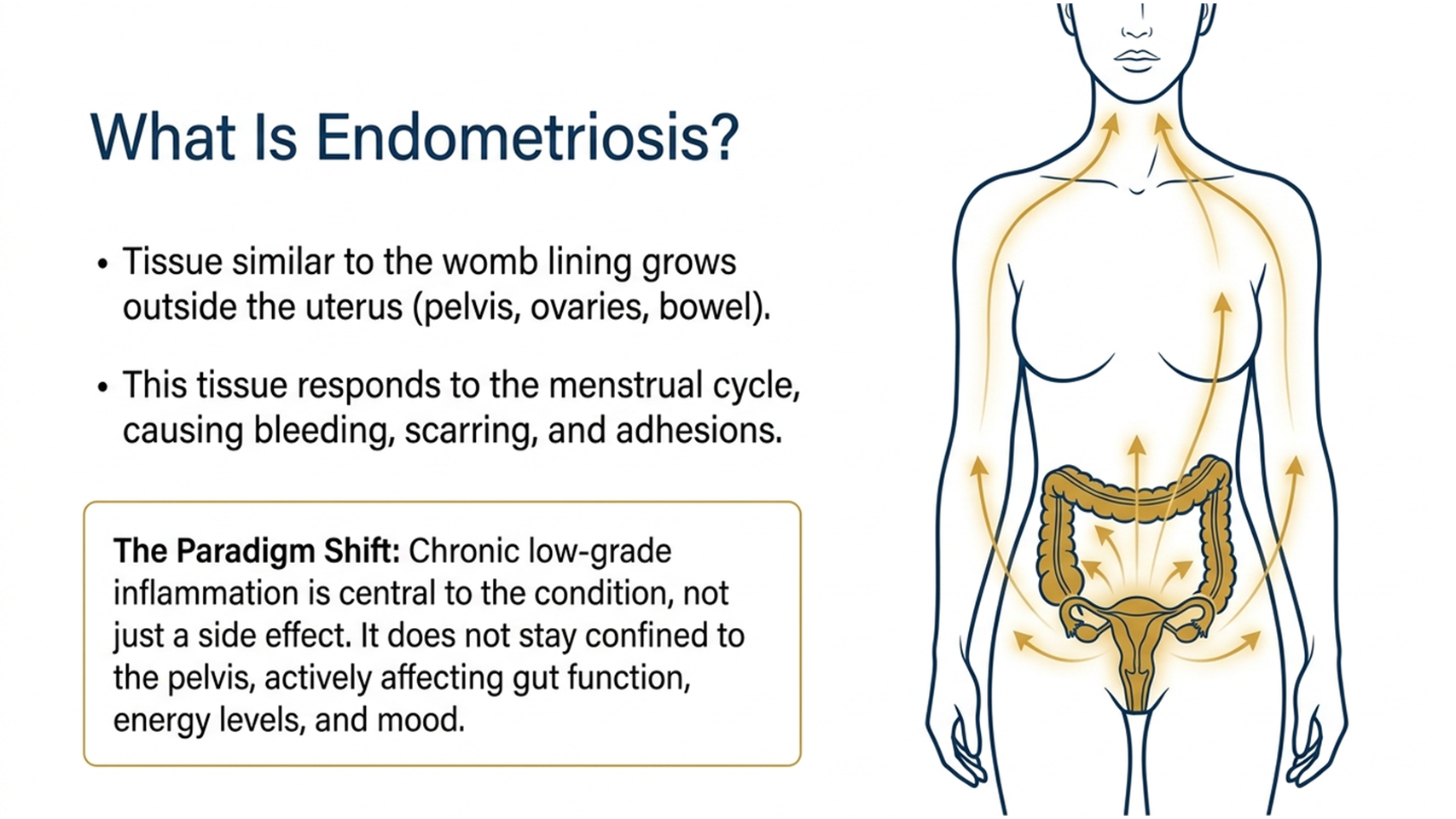 what is endometriosis diagram showing tissue outside the uterus