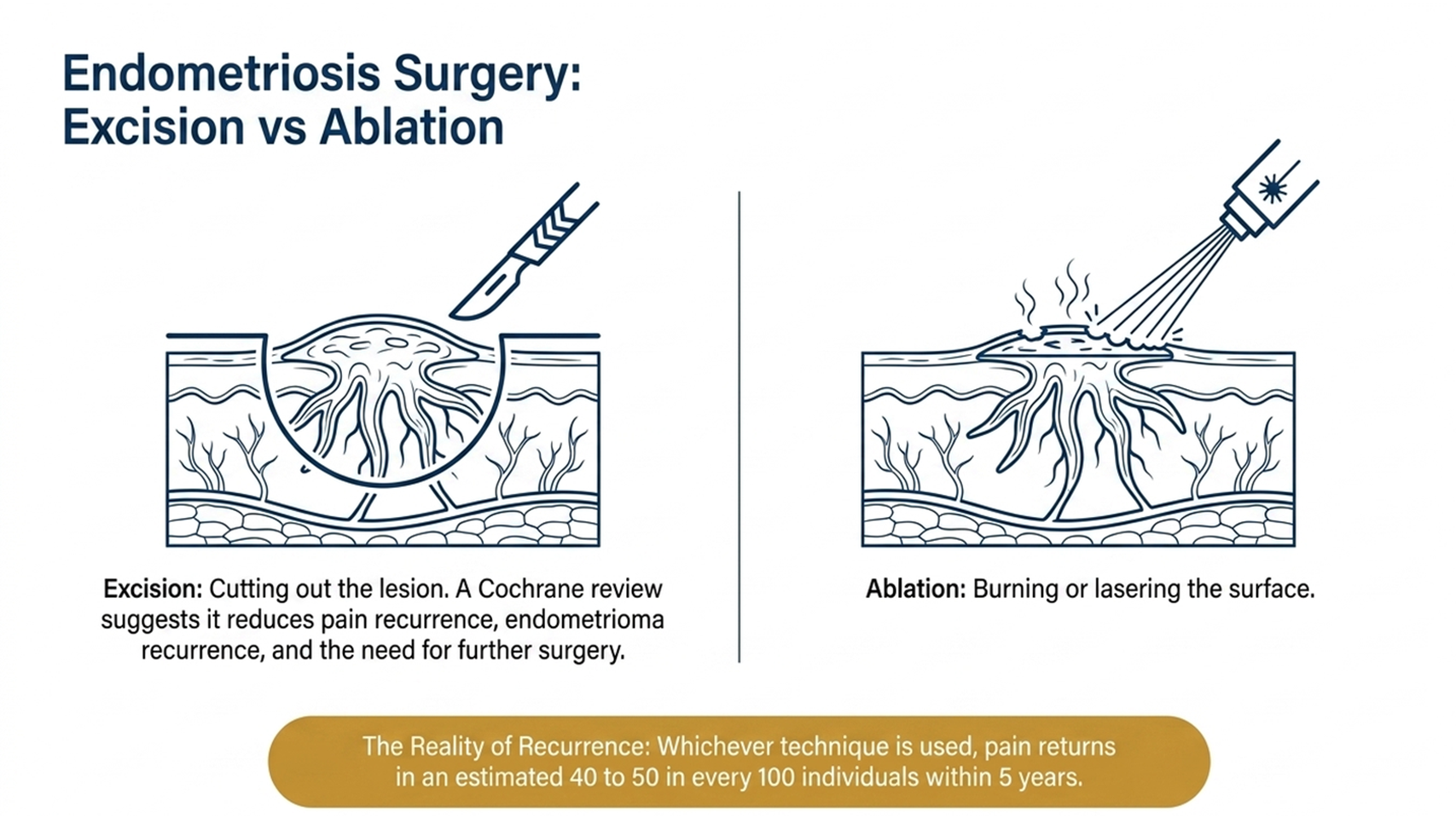 endometriosis surgery, excision vs ablation